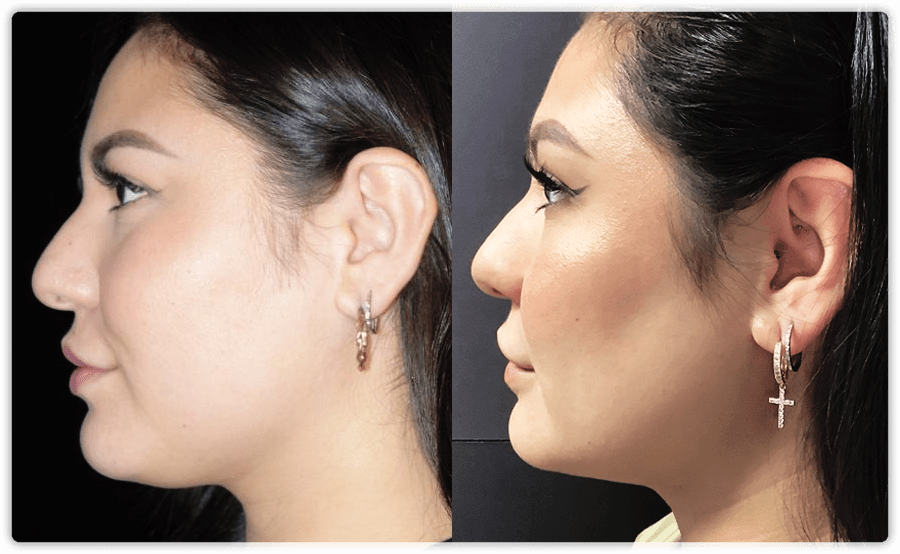 Kybella Double Chin Treatments In Toronto & Mississauga | Lip Doctor